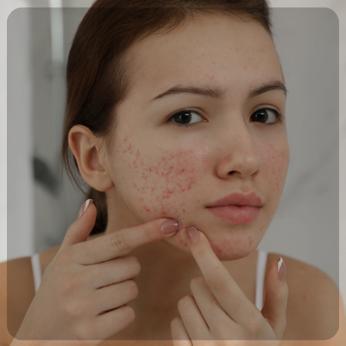 Acne Skin