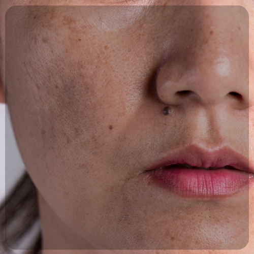 Pigmentation skin