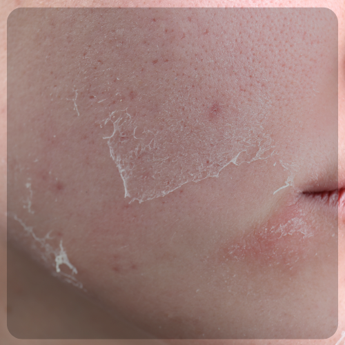 Dry Skin