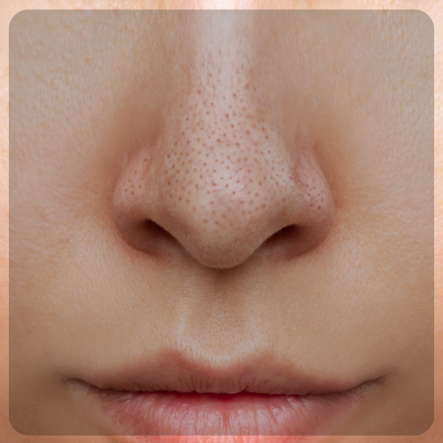 Black Heads