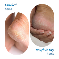 Be Bodywise 20% Urea Foot Roll On for Cracked Heels