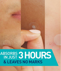 Blemish Barrier Patches – Fast-Acting Acne Healing & Protection