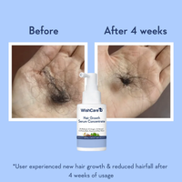 WishCare Hair Growth Serum Concentrate | 3% Redensyl, 4% Anagain, Rice Water, Rosemary & Biotin | Clinically Proven Hair Serum | 30ml